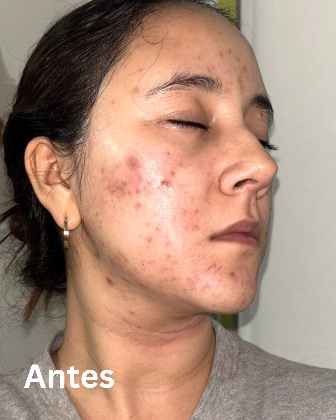 Kit Anti-Acné Esencial