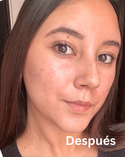 Kit Anti-Acné Esencial