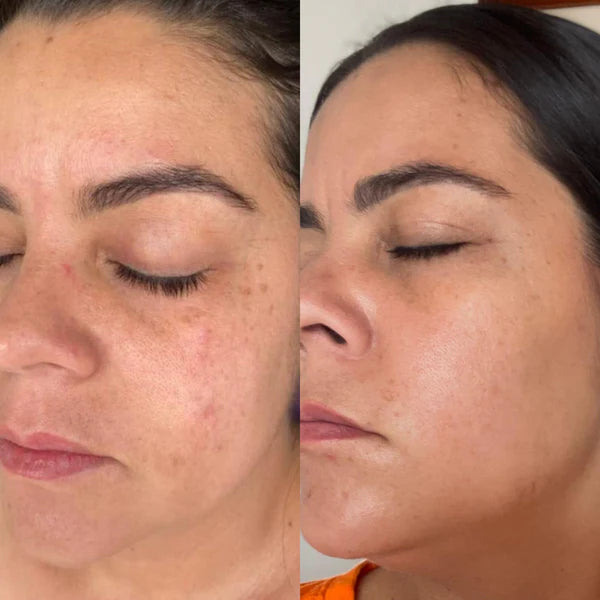 Kit Anti-Manchas Ultra: Kit de Cuidado Facial para eliminar manchas